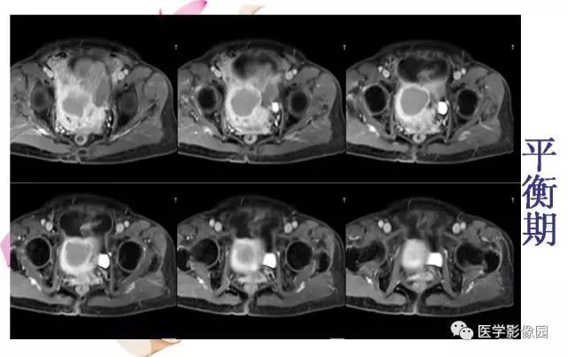 【病例】下腹腔胃肠道外间质瘤1例MR影像表现 【病例】下腹腔胃肠道外间质瘤1例MR影像表现