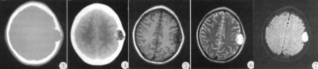 【病例】颅骨表皮样囊肿1例CT及MR影像表现 【病例】颅骨表皮样囊肿1例CT及MR影像表现