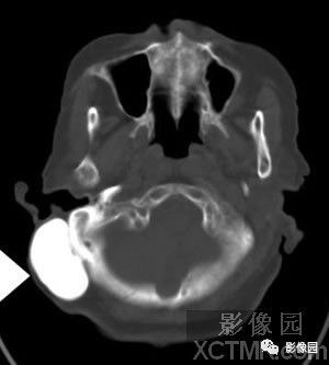 【病例】右侧枕骨致密骨瘤1例CT影像诊断分析