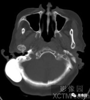 【病例】右侧枕骨致密骨瘤1例CT影像诊断分析 【病例】右侧枕骨致密骨瘤1例CT影像诊断分析