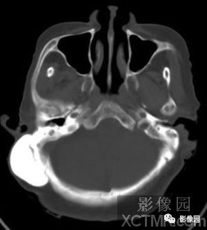【病例】右侧枕骨致密骨瘤1例CT影像诊断分析 【病例】右侧枕骨致密骨瘤1例CT影像诊断分析