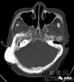 【病例】右侧枕骨致密骨瘤1例CT影像诊断分析 【病例】右侧枕骨致密骨瘤1例CT影像诊断分析