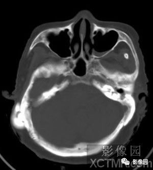 【病例】右侧枕骨致密骨瘤1例CT影像诊断分析 【病例】右侧枕骨致密骨瘤1例CT影像诊断分析