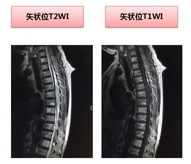 【病例】常见病的不常见表现—笔尖征—椎管内海绵状血管瘤