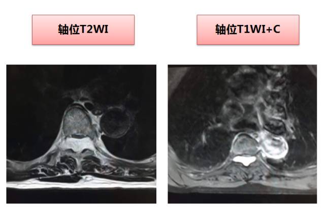【病例】常见病的不常见表现—笔尖征—椎管内海绵状血管瘤