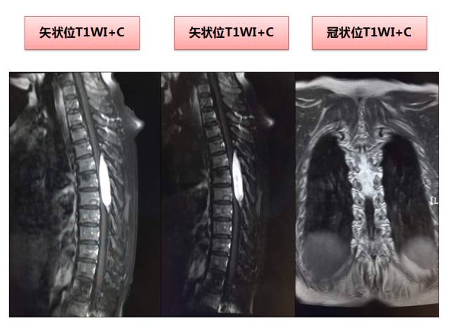 【病例】常见病的不常见表现—笔尖征—椎管内海绵状血管瘤