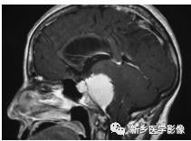 长在斜坡上的9种肿瘤