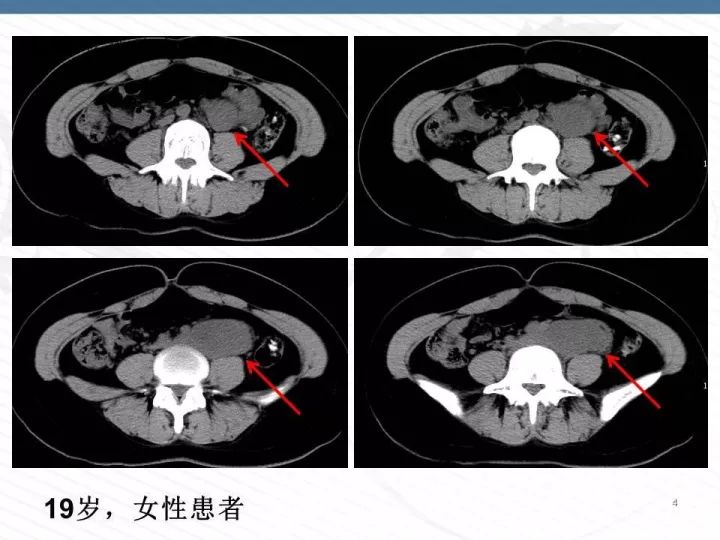 【PPT】腹膜后神经节细胞瘤误诊分析
