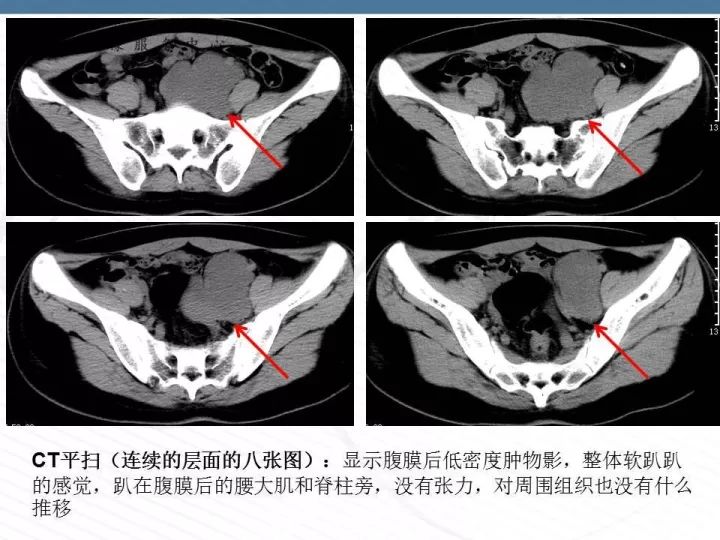 【PPT】腹膜后神经节细胞瘤误诊分析