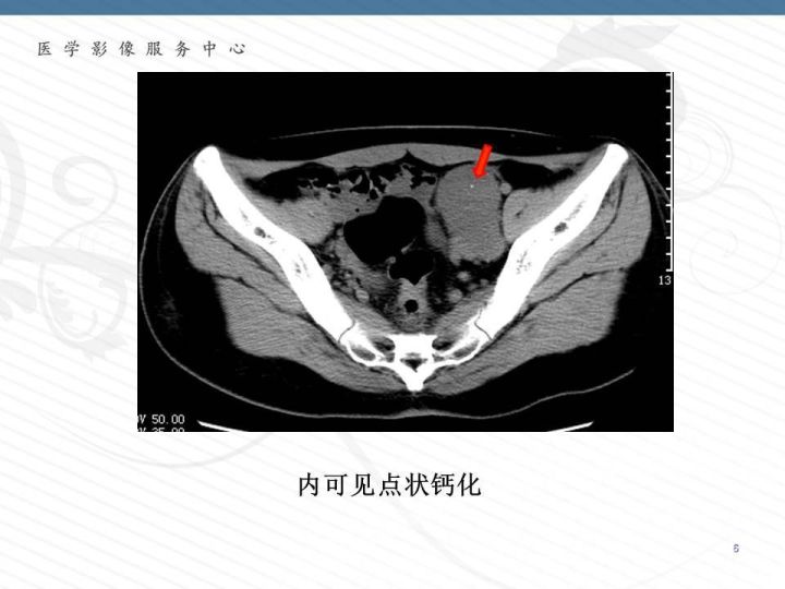 【PPT】腹膜后神经节细胞瘤误诊分析
