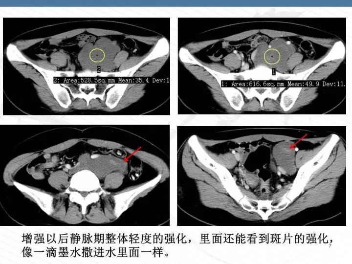【PPT】腹膜后神经节细胞瘤误诊分析