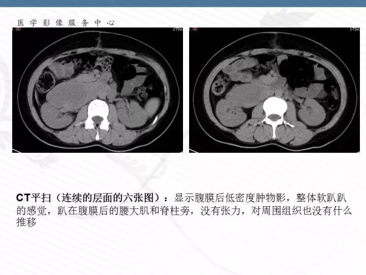 【PPT】腹膜后神经节细胞瘤误诊分析