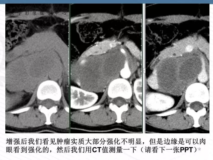 【PPT】腹膜后神经节细胞瘤误诊分析