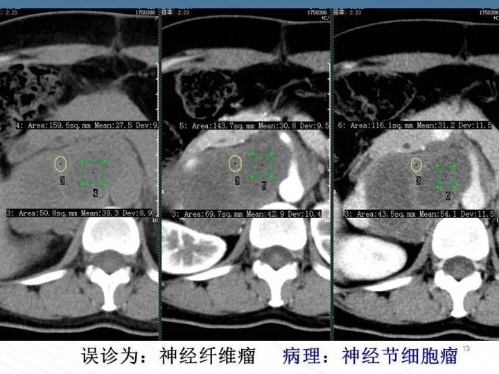 【PPT】腹膜后神经节细胞瘤误诊分析