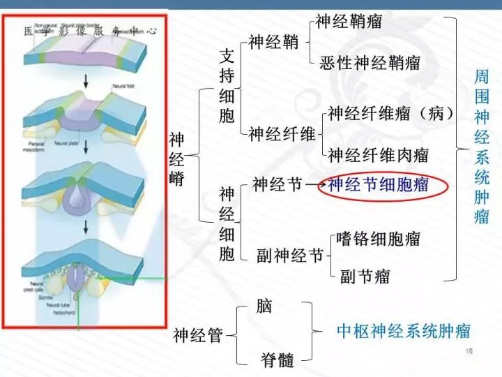 【PPT】腹膜后神经节细胞瘤误诊分析