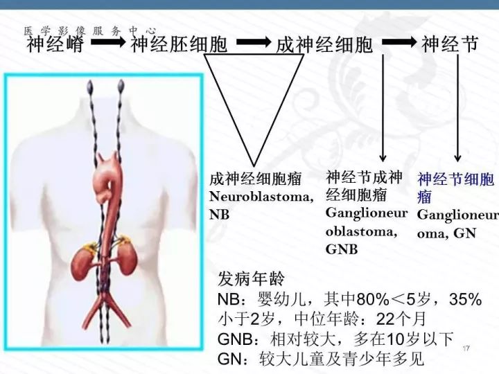 【PPT】腹膜后神经节细胞瘤误诊分析