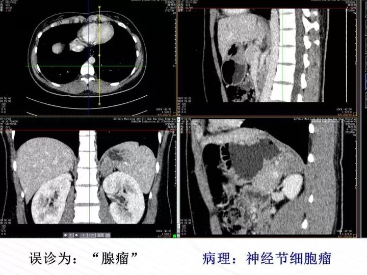 【PPT】腹膜后神经节细胞瘤误诊分析