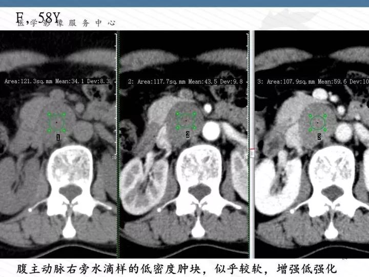 【PPT】腹膜后神经节细胞瘤误诊分析