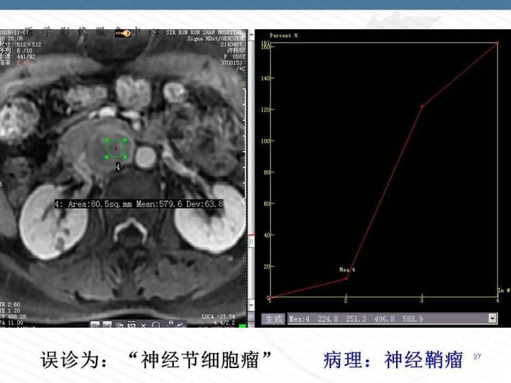 【PPT】腹膜后神经节细胞瘤误诊分析