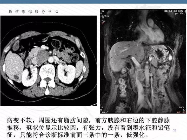 【PPT】腹膜后神经节细胞瘤误诊分析