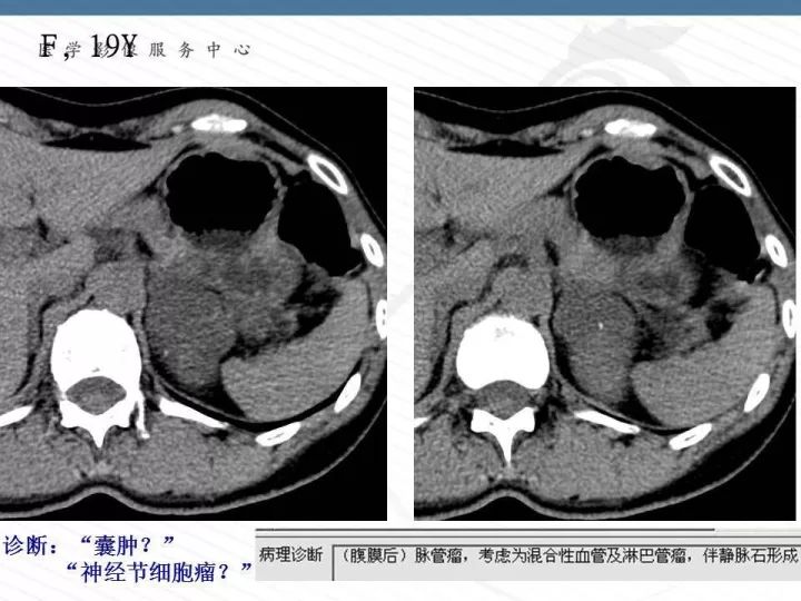 【PPT】腹膜后神经节细胞瘤误诊分析