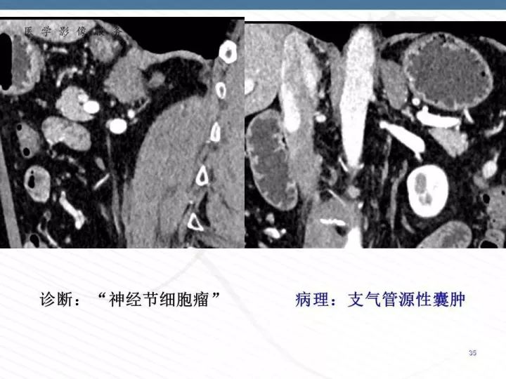 【PPT】腹膜后神经节细胞瘤误诊分析