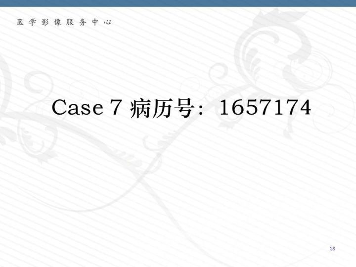 【PPT】腹膜后神经节细胞瘤误诊分析