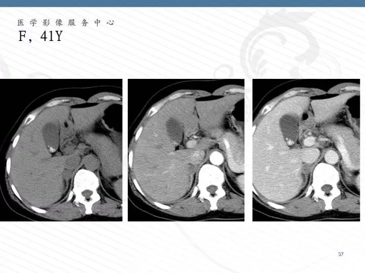 【PPT】腹膜后神经节细胞瘤误诊分析