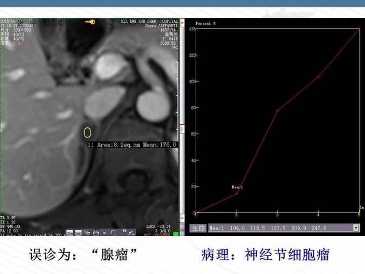 【PPT】腹膜后神经节细胞瘤误诊分析
