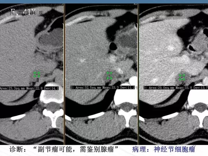 【PPT】腹膜后神经节细胞瘤误诊分析