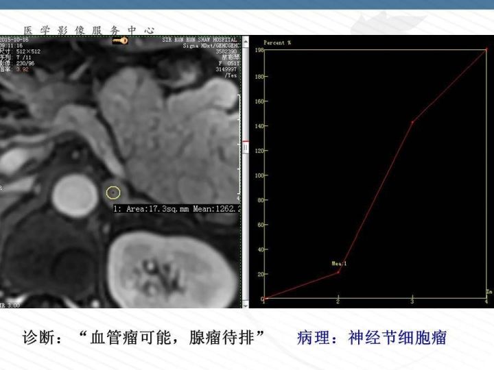 【PPT】腹膜后神经节细胞瘤误诊分析