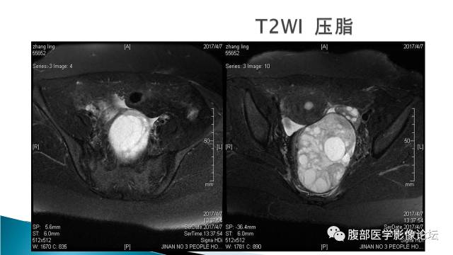 【病例】盆腔孤立性纤维性肿瘤1例MR影像表现 【病例】盆腔孤立性纤维性肿瘤1例MR影像表现