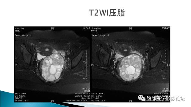 【病例】盆腔孤立性纤维性肿瘤1例MR影像表现 【病例】盆腔孤立性纤维性肿瘤1例MR影像表现
