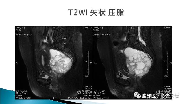 【病例】盆腔孤立性纤维性肿瘤1例MR影像表现 【病例】盆腔孤立性纤维性肿瘤1例MR影像表现