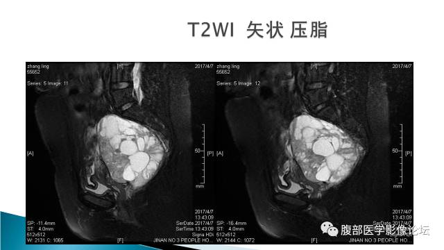 【病例】盆腔孤立性纤维性肿瘤1例MR影像表现 【病例】盆腔孤立性纤维性肿瘤1例MR影像表现