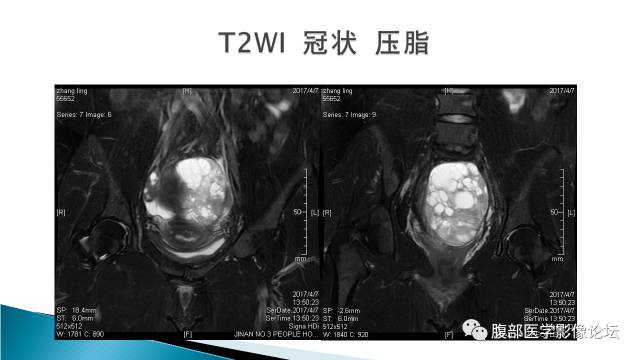 【病例】盆腔孤立性纤维性肿瘤1例MR影像表现 【病例】盆腔孤立性纤维性肿瘤1例MR影像表现
