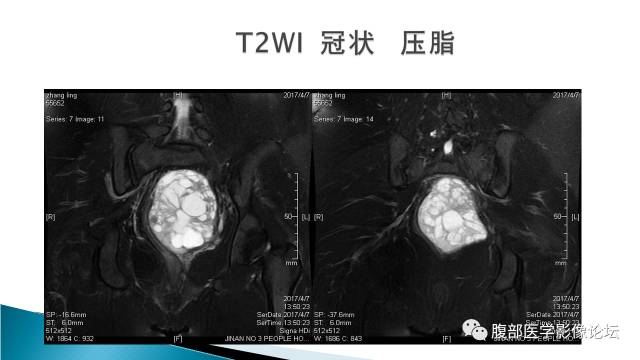 【病例】盆腔孤立性纤维性肿瘤1例MR影像表现 【病例】盆腔孤立性纤维性肿瘤1例MR影像表现