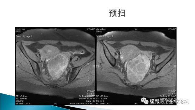 【病例】盆腔孤立性纤维性肿瘤1例MR影像表现 【病例】盆腔孤立性纤维性肿瘤1例MR影像表现