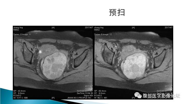 【病例】盆腔孤立性纤维性肿瘤1例MR影像表现 【病例】盆腔孤立性纤维性肿瘤1例MR影像表现