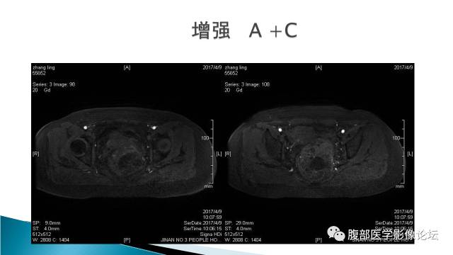 【病例】盆腔孤立性纤维性肿瘤1例MR影像表现 【病例】盆腔孤立性纤维性肿瘤1例MR影像表现