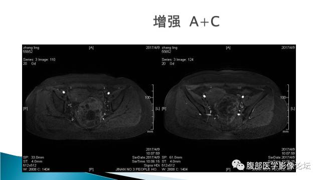 【病例】盆腔孤立性纤维性肿瘤1例MR影像表现 【病例】盆腔孤立性纤维性肿瘤1例MR影像表现