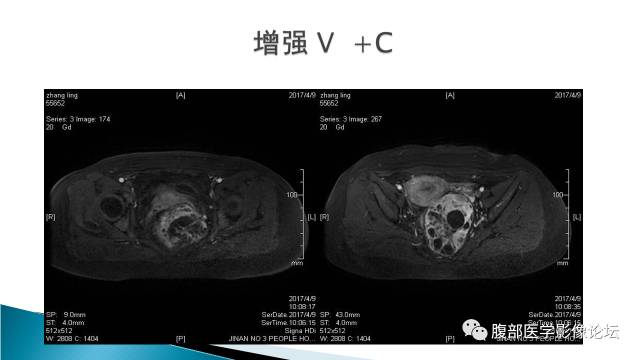 【病例】盆腔孤立性纤维性肿瘤1例MR影像表现 【病例】盆腔孤立性纤维性肿瘤1例MR影像表现