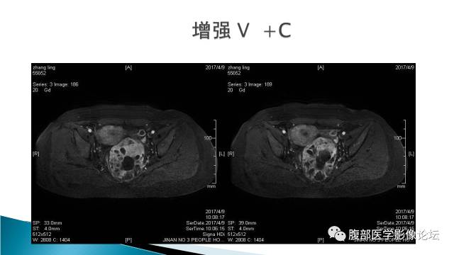 【病例】盆腔孤立性纤维性肿瘤1例MR影像表现 【病例】盆腔孤立性纤维性肿瘤1例MR影像表现