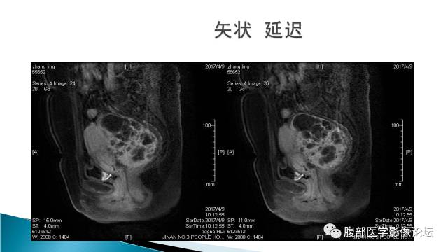 【病例】盆腔孤立性纤维性肿瘤1例MR影像表现 【病例】盆腔孤立性纤维性肿瘤1例MR影像表现