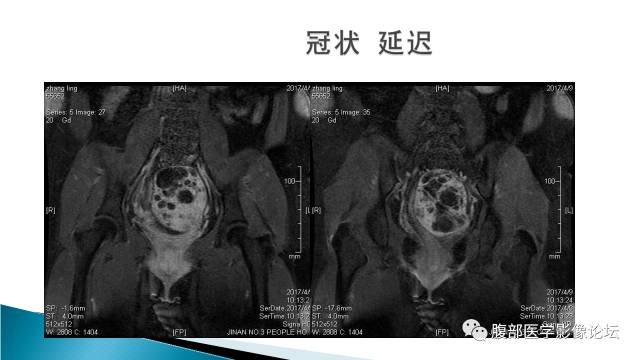 【病例】盆腔孤立性纤维性肿瘤1例MR影像表现 【病例】盆腔孤立性纤维性肿瘤1例MR影像表现