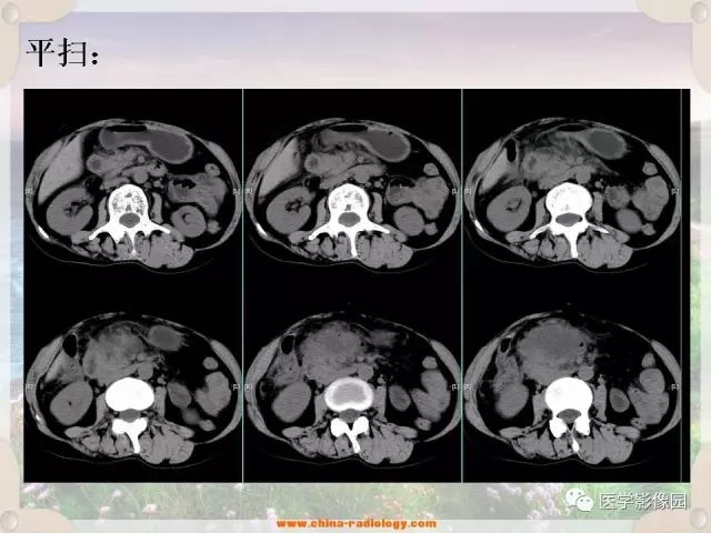 【病例】腹腔侵袭性纤维瘤病1例CT影像表现 【病例】腹腔侵袭性纤维瘤病1例CT影像表现