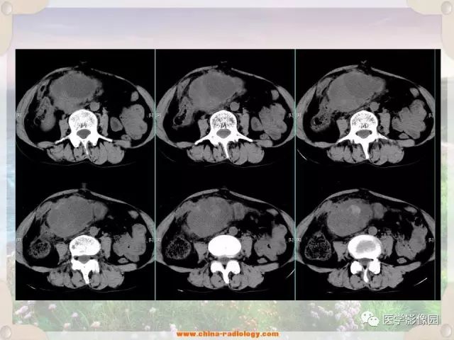 【病例】腹腔侵袭性纤维瘤病1例CT影像表现 【病例】腹腔侵袭性纤维瘤病1例CT影像表现