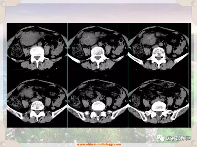 【病例】腹腔侵袭性纤维瘤病1例CT影像表现 【病例】腹腔侵袭性纤维瘤病1例CT影像表现