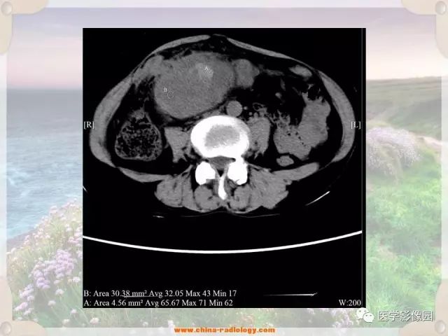 【病例】腹腔侵袭性纤维瘤病1例CT影像表现 【病例】腹腔侵袭性纤维瘤病1例CT影像表现