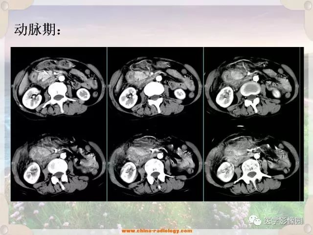 【病例】腹腔侵袭性纤维瘤病1例CT影像表现 【病例】腹腔侵袭性纤维瘤病1例CT影像表现